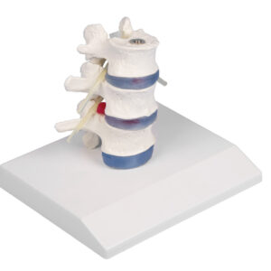 Model lumbalne kralježnice sa prolapsom intervertebralnog diska na staklu, slika 1